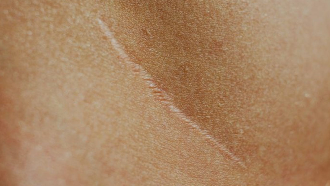 Fibrosis is the simple disease process that’s more important than you think