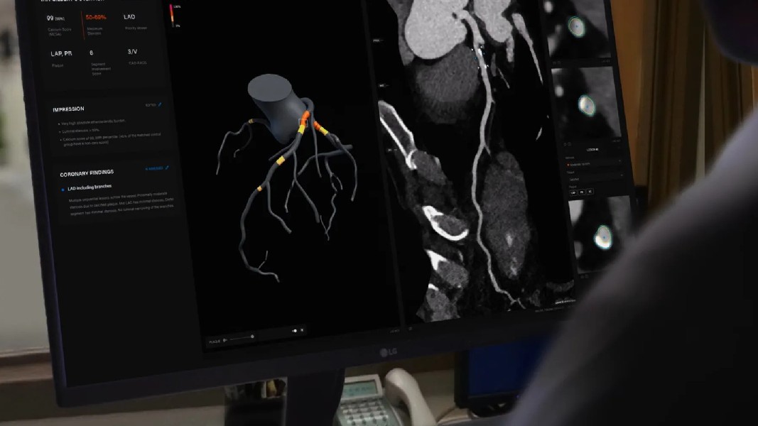 Artrya seeking to improve its chances of getting FDA approval for AI heart disease screener
